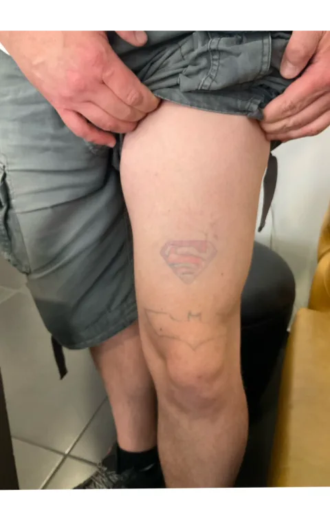 Before: Cover-up on the thigh: old tattoo covered with a new design